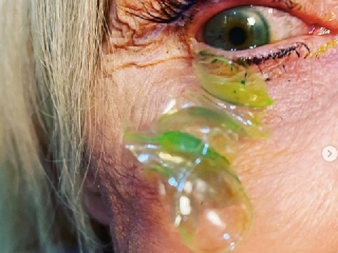 Khó tin: 23 lớp kính áp tròng trên mắt người phụ nữ